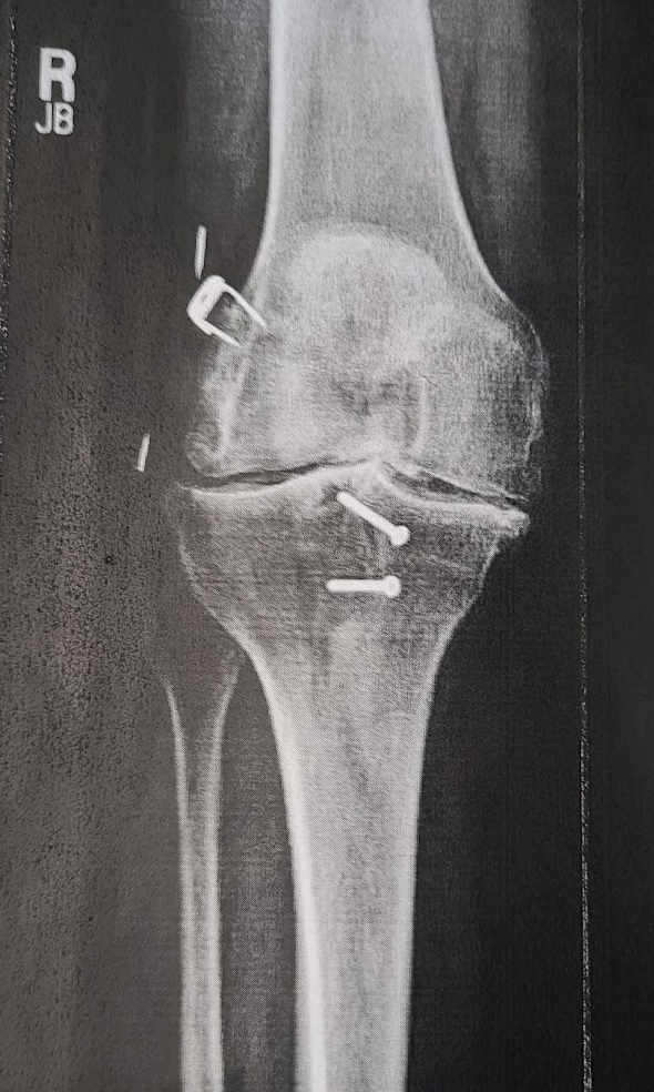 Right knee — bone on bone